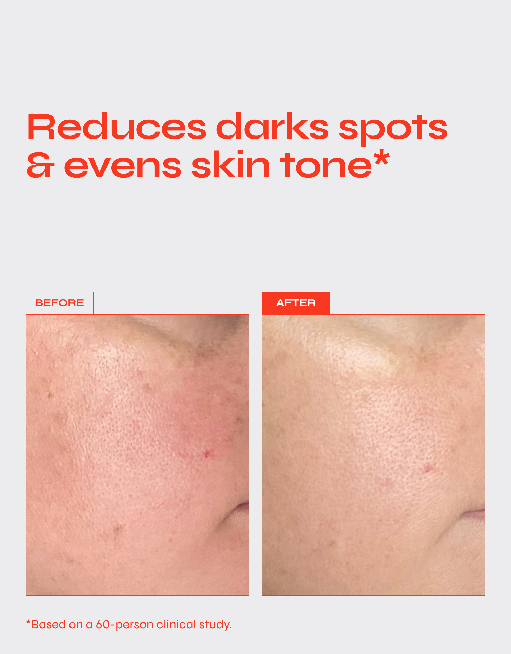 BRIGHTEN Tranexamic & Azelaic Acid Serum for Dark Spots & Hyperpigmentation