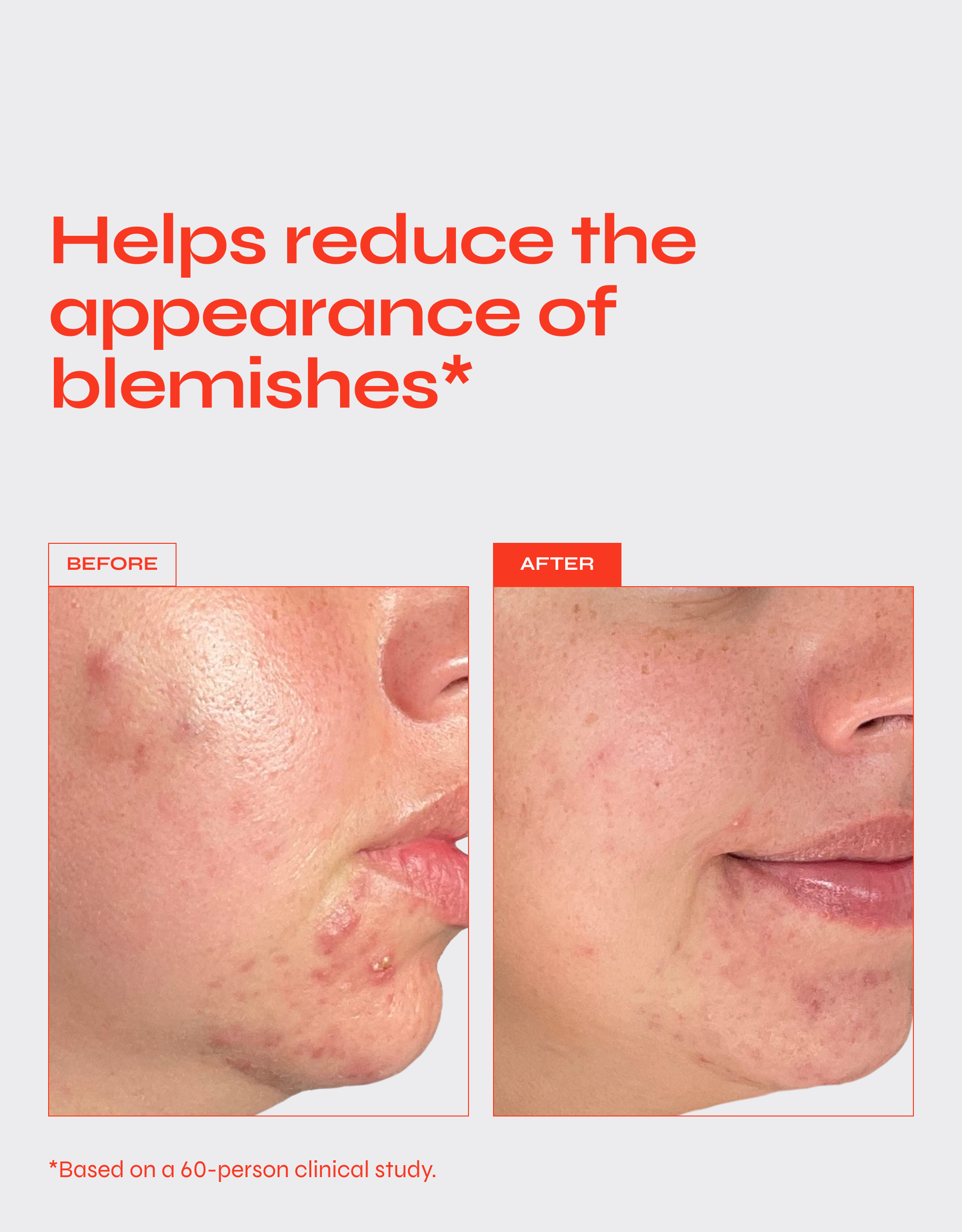 CLEAR Exfoliating Serum for Blemishes with 7% Glycolic Acid & 3% Lactic Acid